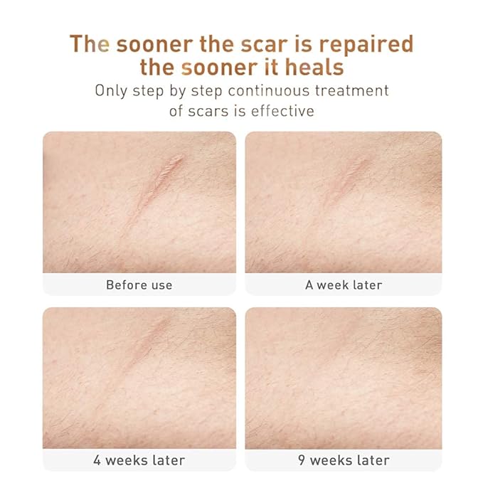 Acne Scar Removal Cream Stretch Marks (Packaging