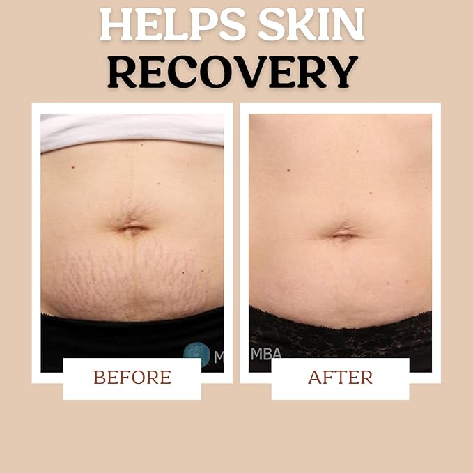 Stretch Mark Cream for Sensitive Skin Long