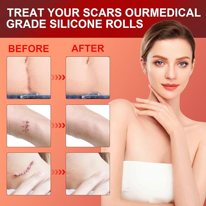 Silicone Scar Sheets (1.6¡±x 60¡± Roll-1.5M),