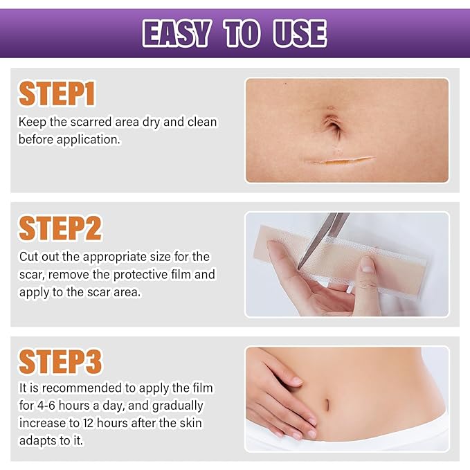 Silicone Scar Sheets,Silicone Scar Tape,Scar Tape
