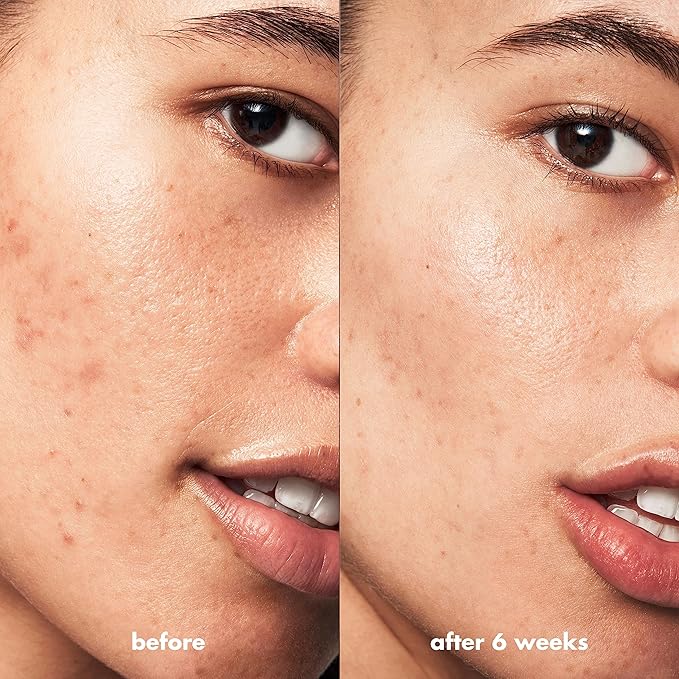e.l.f. SKIN Blemish Breakthrough Blemish Control