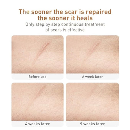 Acne Scar Removal Cream Stretch Marks (Packaging