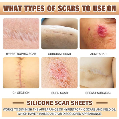 Silicone Scar Sheets,Silicone Scar Tape,Silicone Sheets