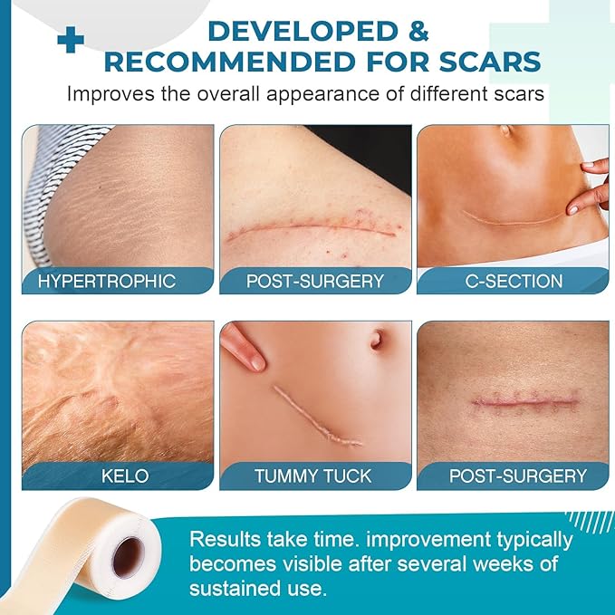 Silicone Scar Sheets, Silicone Scar Tape(1.6¡±x