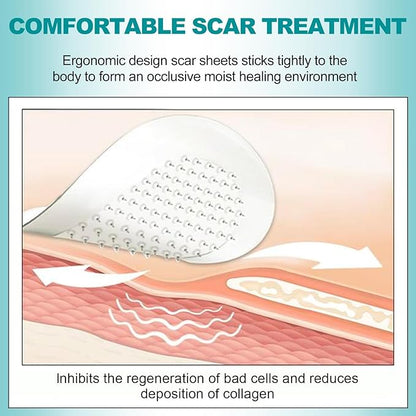 Extra Long Silicone Scar Sheets (1.6”