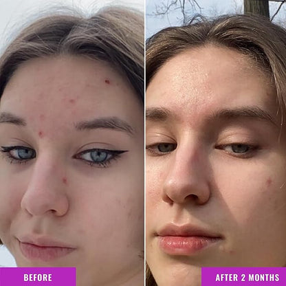 Good Molecules Niacinamide Serum - 10% Niacinamide B3 Facial Serum for Blemishes, Enlarged Pores, Balancing and Hydrating - Skincare for Face