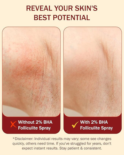 2% BHA Folliculitis Body Oil Spray - Salicylic Acid Body Mist with Tea Tree Oil & Aloe Vera - Spray Moisturizer for Dry Skin, Clogged Pores & Irritation, 4 fl. oz